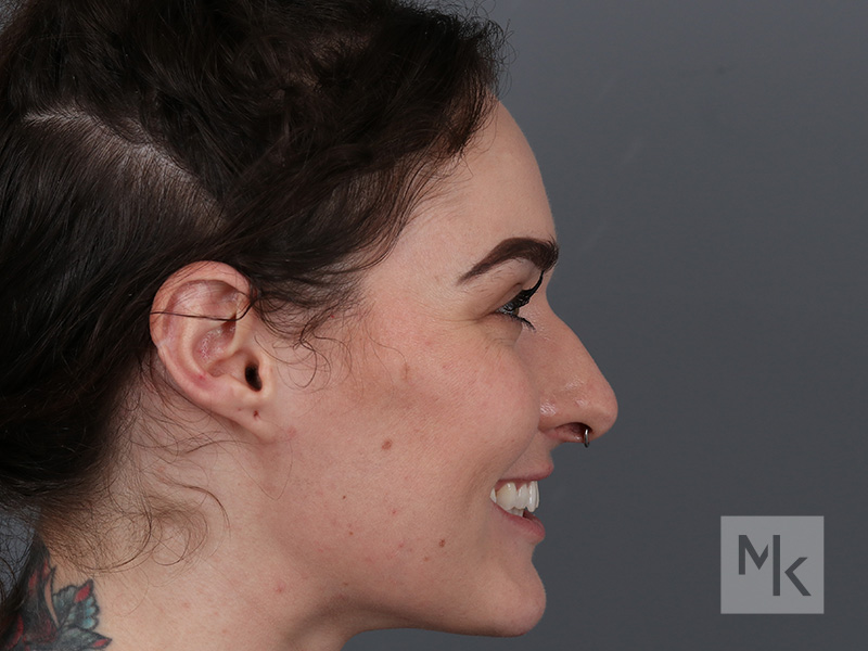 Rhinoplasty Before and After | Dr. Michael Kim