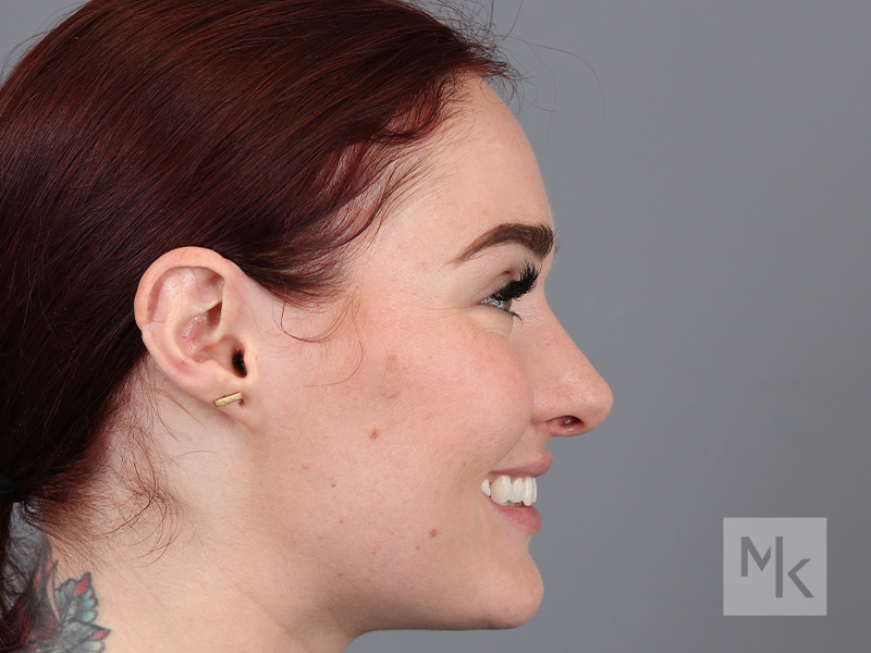 Rhinoplasty Before and After | Dr. Michael Kim