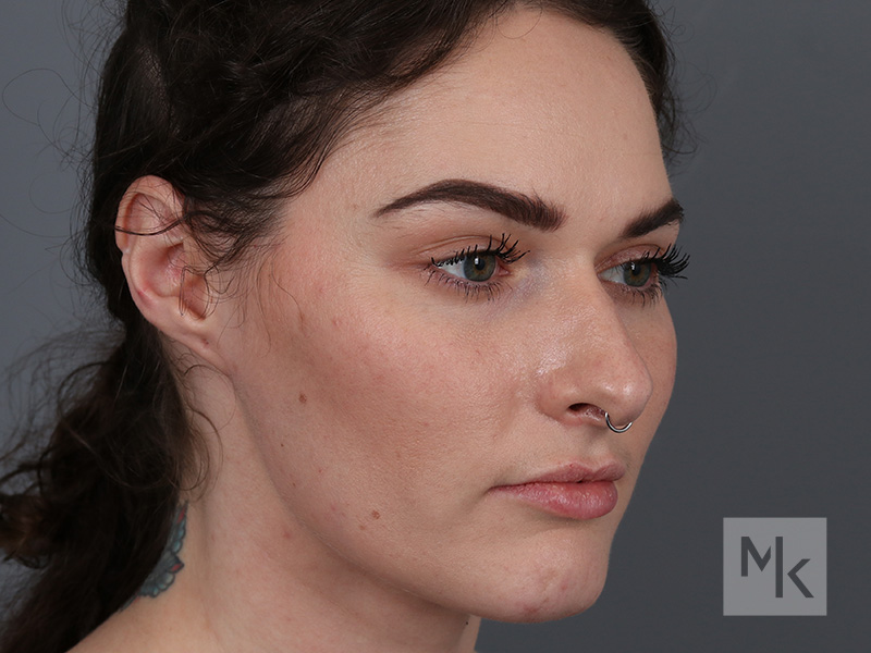 Rhinoplasty Before and After | Dr. Michael Kim