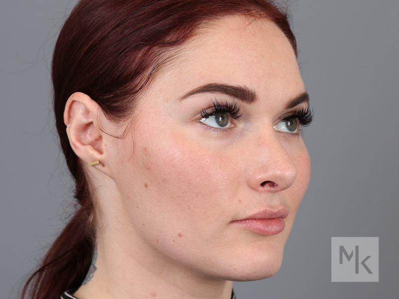 Rhinoplasty Before and After | Dr. Michael Kim