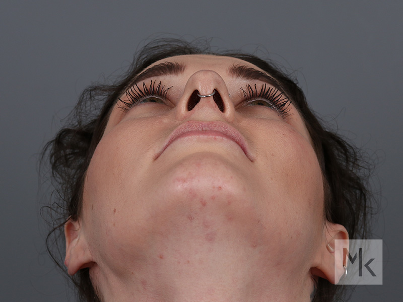 Rhinoplasty Before and After | Dr. Michael Kim