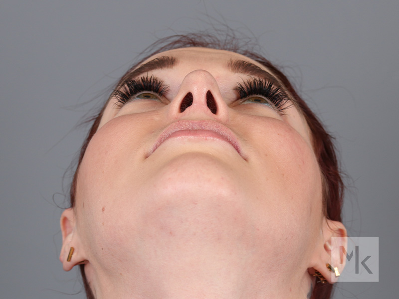 Rhinoplasty Before and After | Dr. Michael Kim