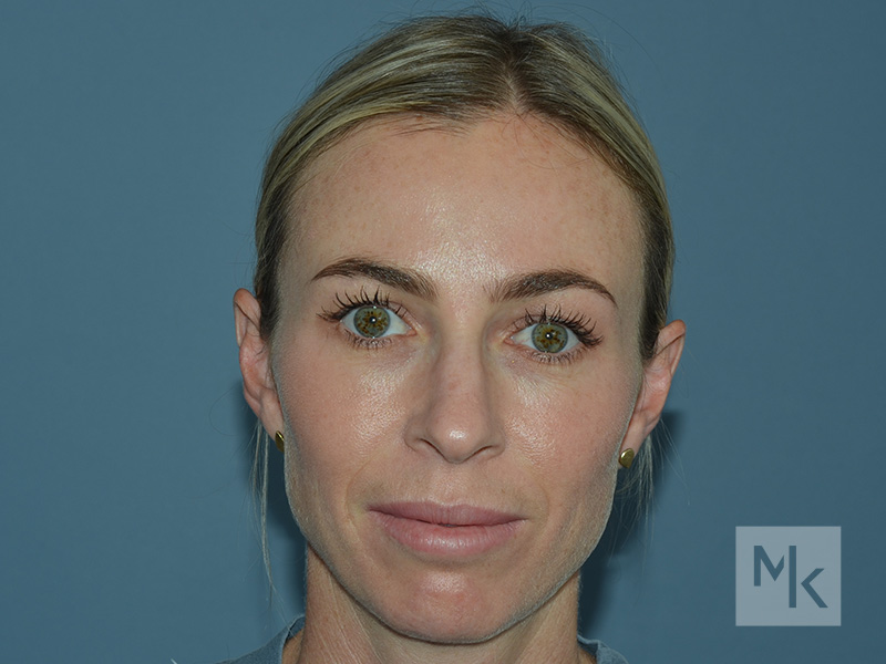 Rhinoplasty Before and After | Dr. Michael Kim