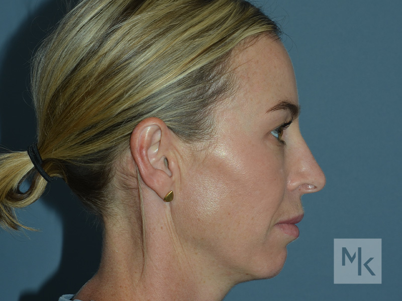 Rhinoplasty Before and After | Dr. Michael Kim