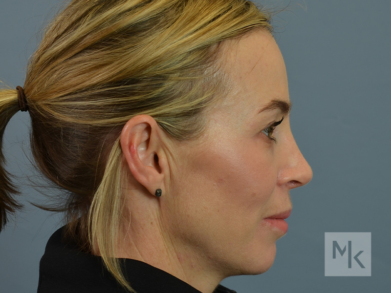 Rhinoplasty Before and After | Dr. Michael Kim