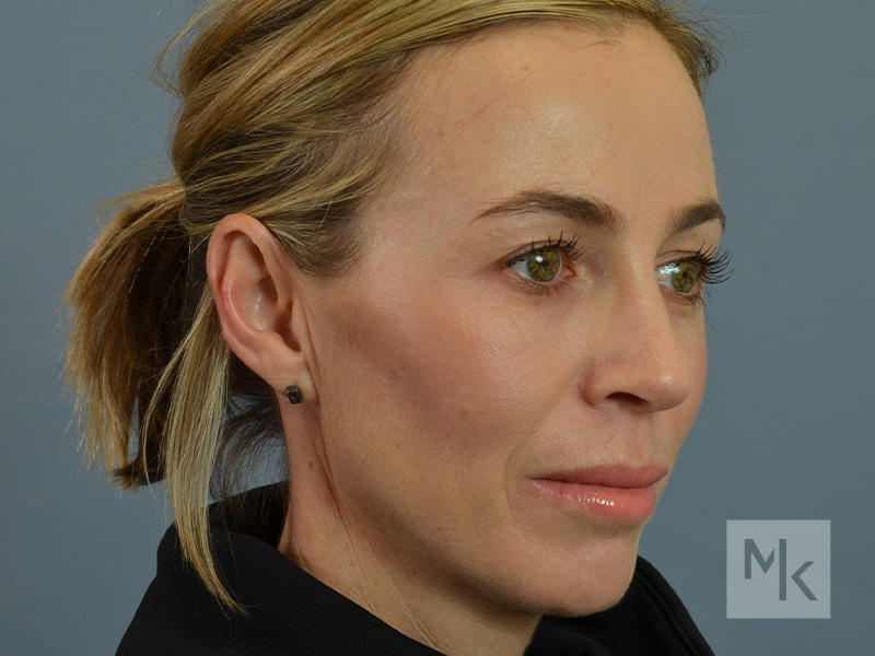 Rhinoplasty Before and After | Dr. Michael Kim