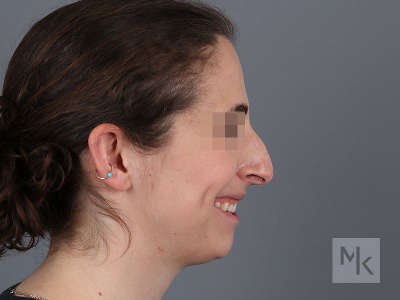 Rhinoplasty Before and After | Dr. Michael Kim