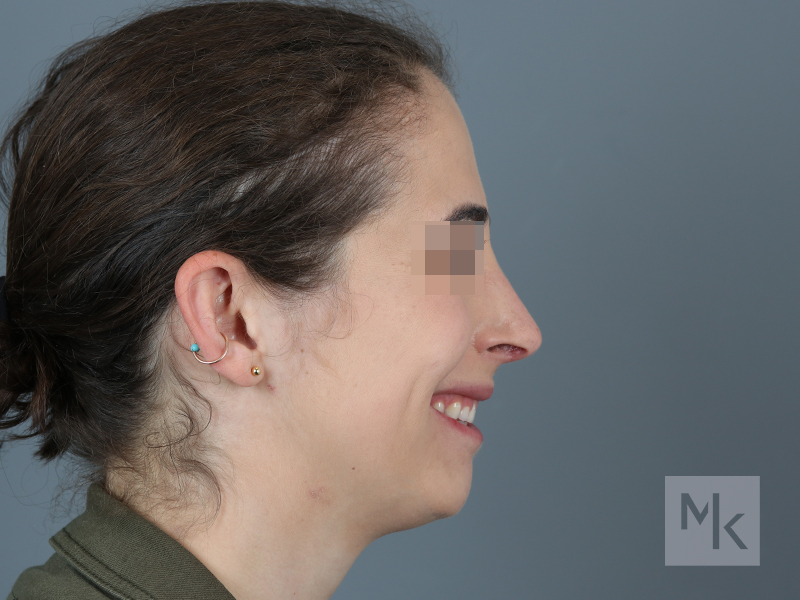 Rhinoplasty Before and After | Dr. Michael Kim