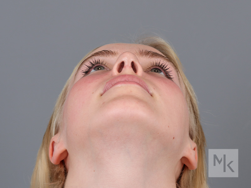 Rhinoplasty Before and After | Dr. Michael Kim