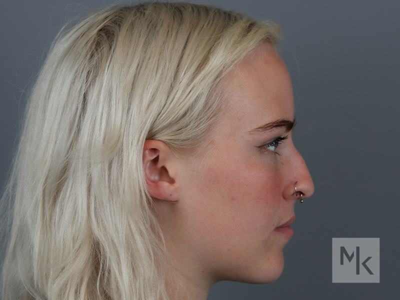 Rhinoplasty Before and After | Dr. Michael Kim