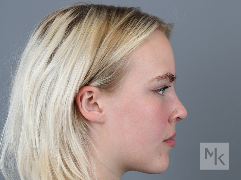 Rhinoplasty Before and After | Dr. Michael Kim