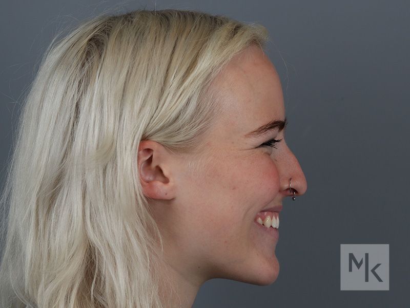 Rhinoplasty Before and After | Dr. Michael Kim
