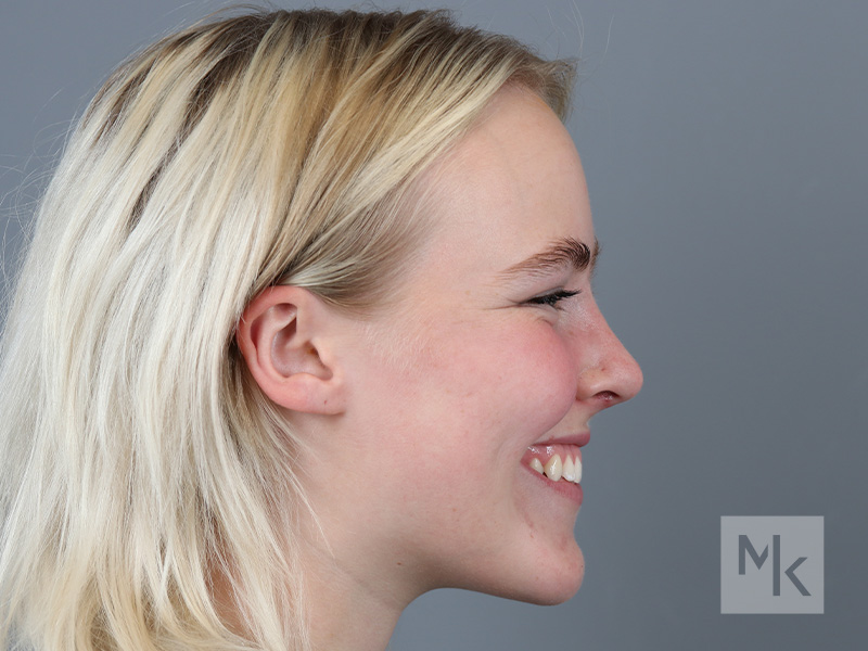 Rhinoplasty Before and After | Dr. Michael Kim