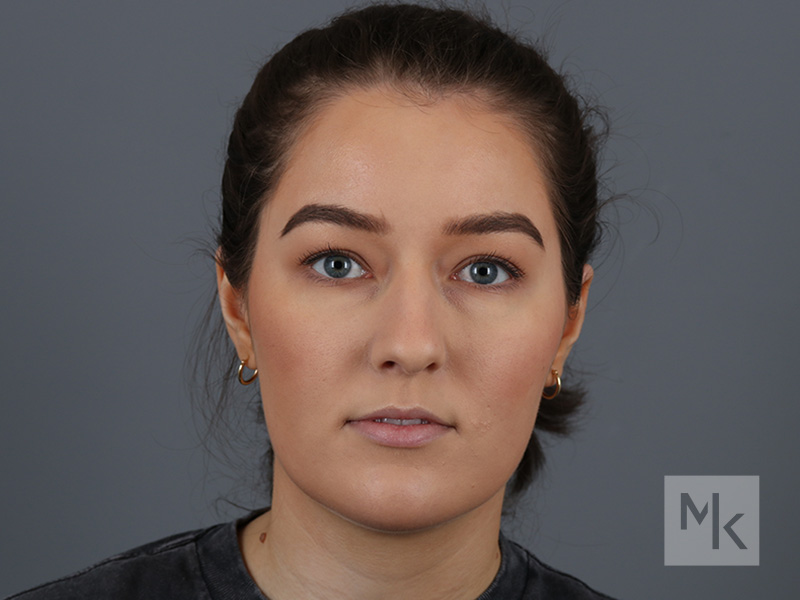 Rhinoplasty Before and After | Dr. Michael Kim