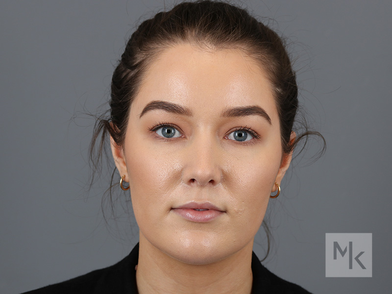 Rhinoplasty Before and After | Dr. Michael Kim