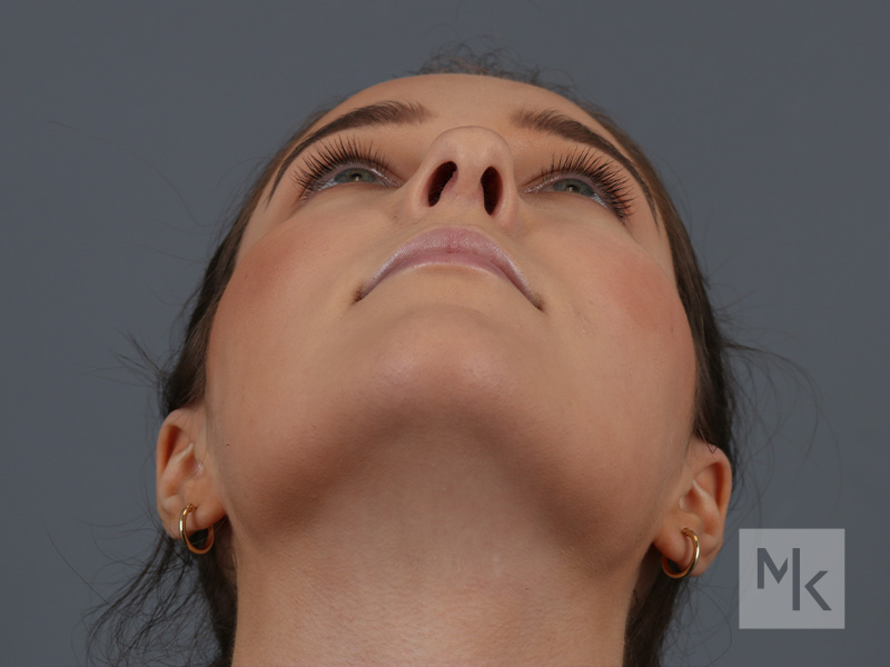 Rhinoplasty Before and After | Dr. Michael Kim