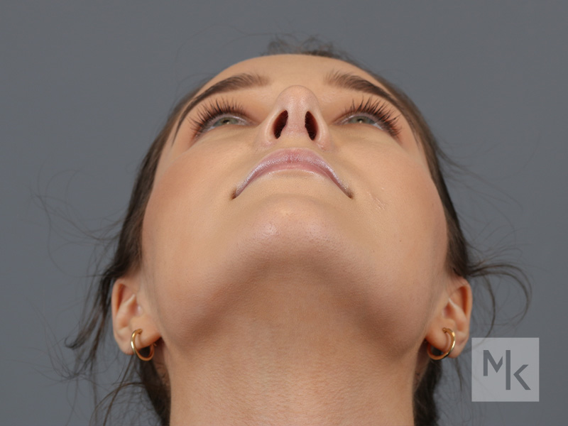 Rhinoplasty Before and After | Dr. Michael Kim