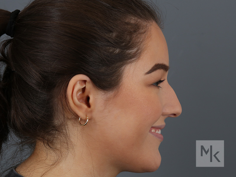Rhinoplasty Before and After | Dr. Michael Kim
