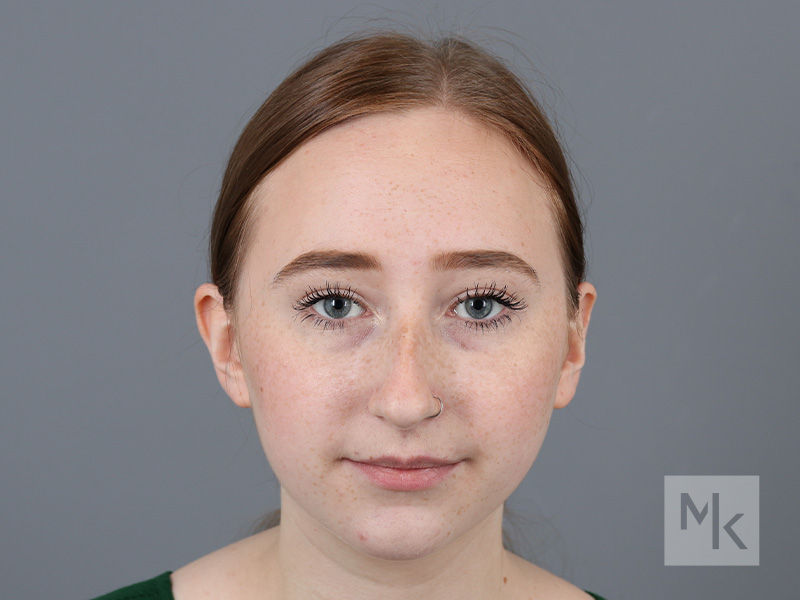 Rhinoplasty Before and After | Dr. Michael Kim