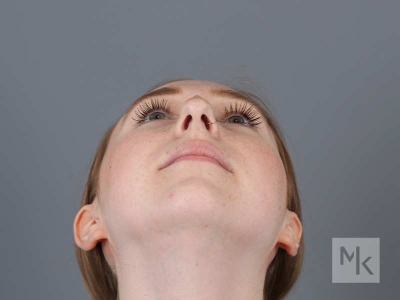 Rhinoplasty Before and After | Dr. Michael Kim