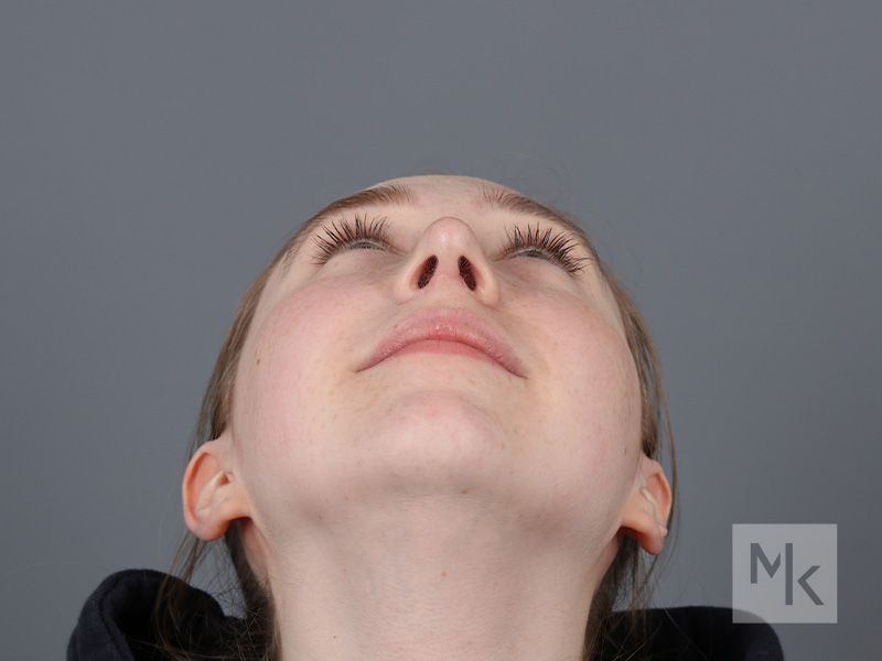 Rhinoplasty Before and After | Dr. Michael Kim