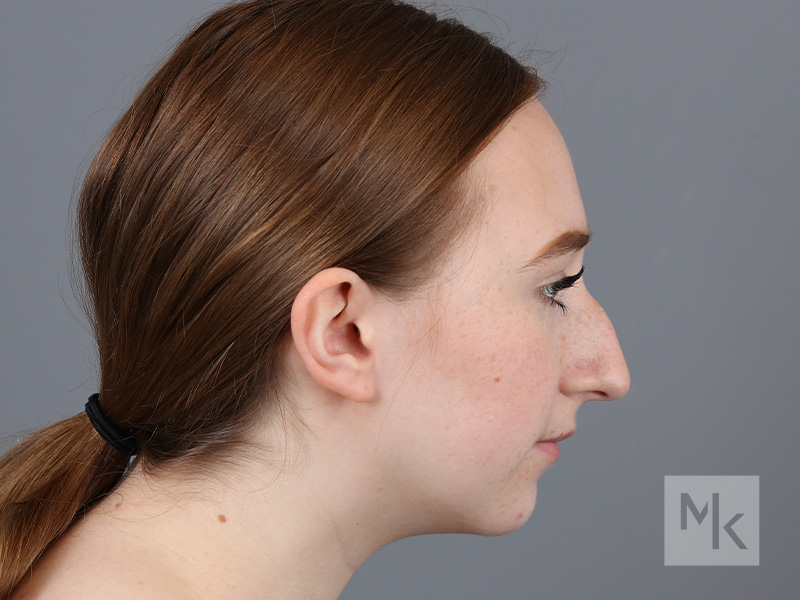 Rhinoplasty Before and After | Dr. Michael Kim