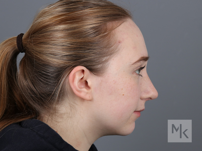 Rhinoplasty Before and After | Dr. Michael Kim