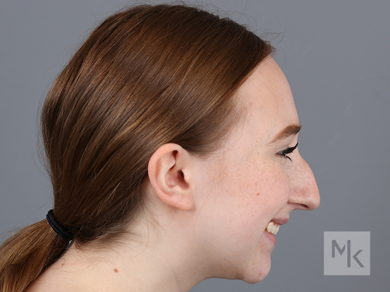 Rhinoplasty Before and After | Dr. Michael Kim