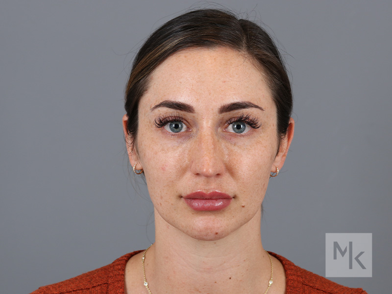 Rhinoplasty Before and After | Dr. Michael Kim