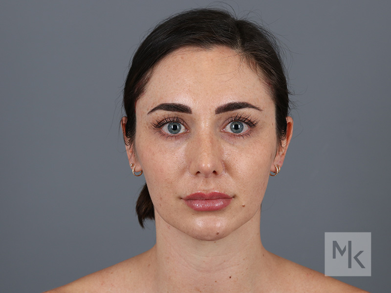 Rhinoplasty Before and After | Dr. Michael Kim