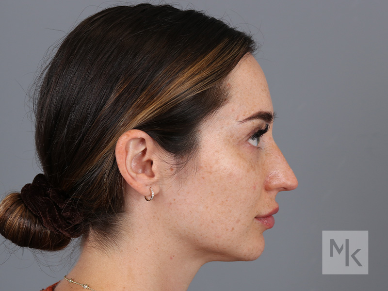 Rhinoplasty Before and After | Dr. Michael Kim