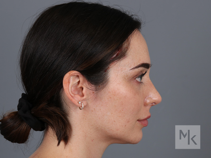 Rhinoplasty Before and After | Dr. Michael Kim