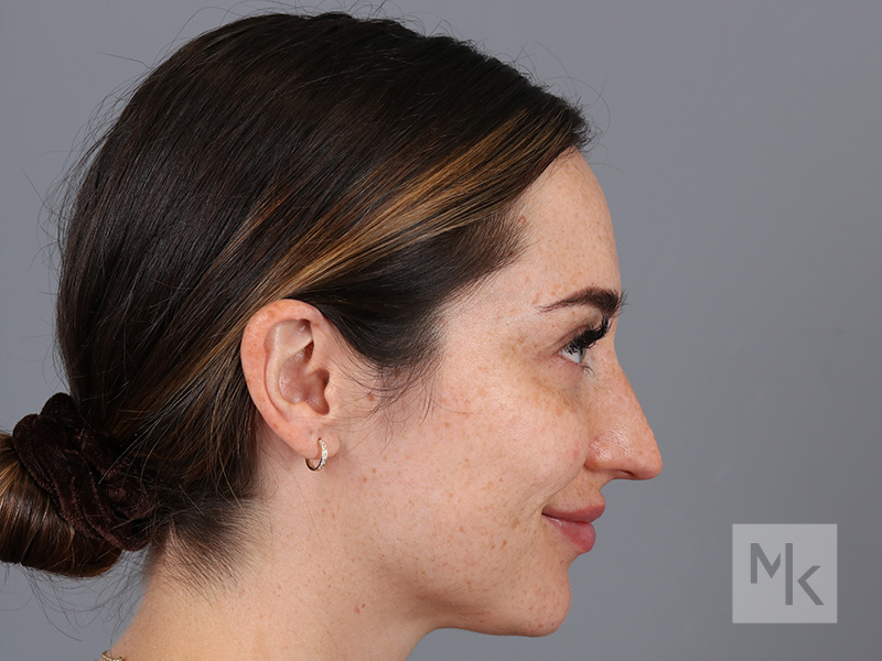 Rhinoplasty Before and After | Dr. Michael Kim