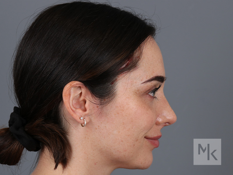 Rhinoplasty Before and After | Dr. Michael Kim