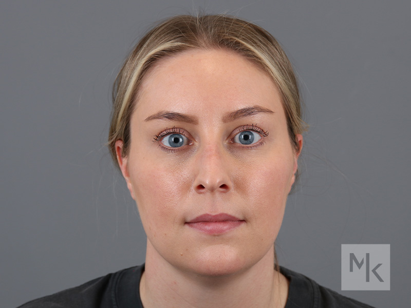 Rhinoplasty Before and After | Dr. Michael Kim