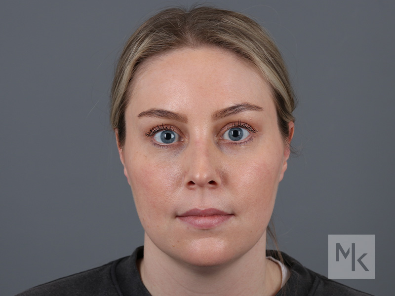 Rhinoplasty Before and After | Dr. Michael Kim