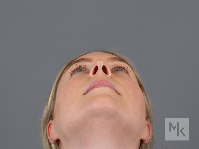 Rhinoplasty Before and After | Dr. Michael Kim