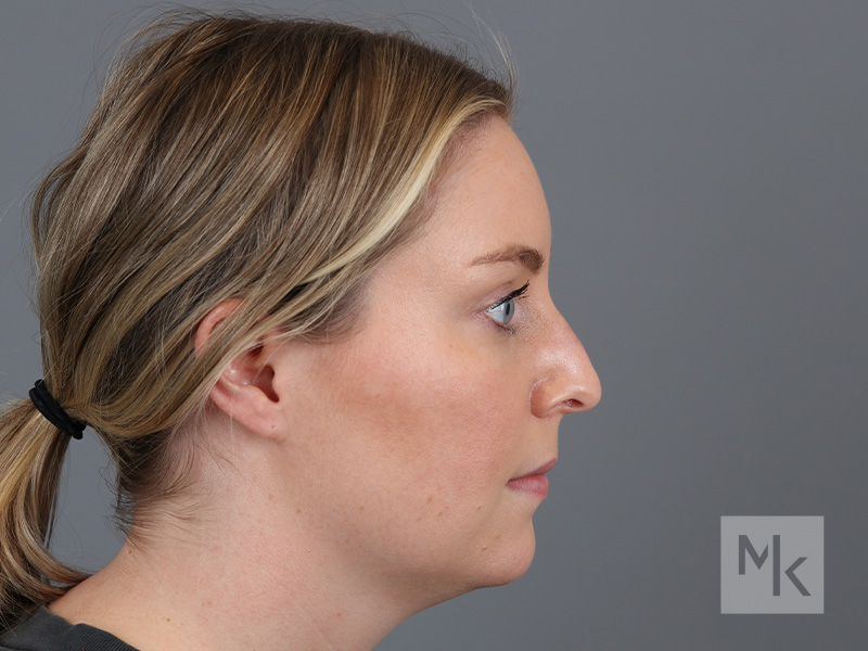 Rhinoplasty Before and After | Dr. Michael Kim