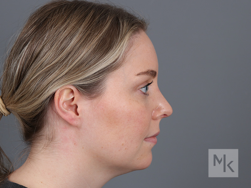 Rhinoplasty Before and After | Dr. Michael Kim