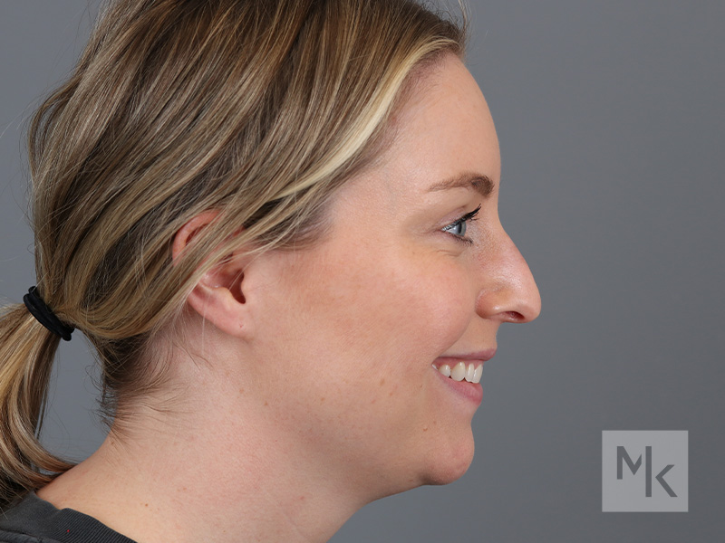 Rhinoplasty Before and After | Dr. Michael Kim