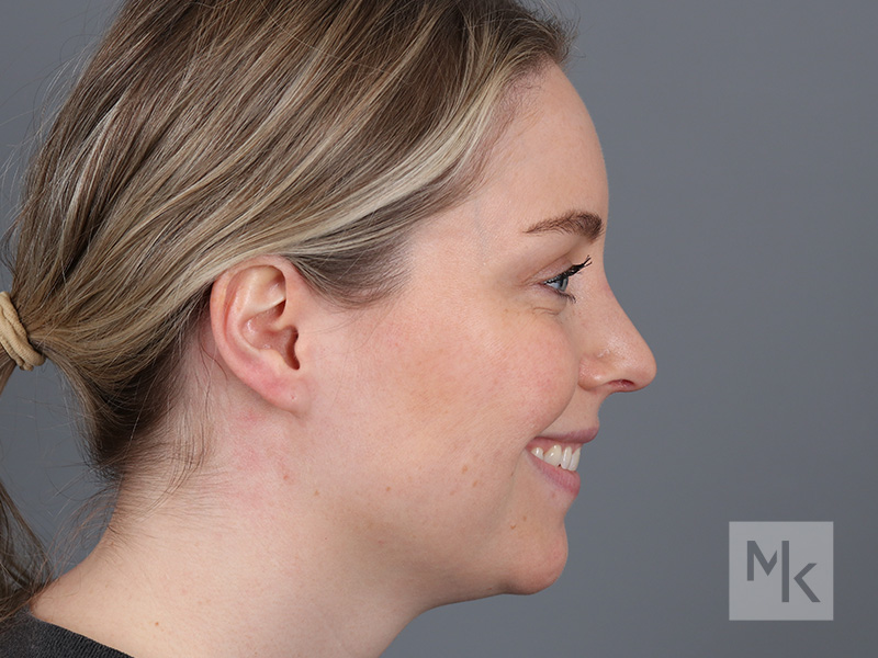 Rhinoplasty Before and After | Dr. Michael Kim