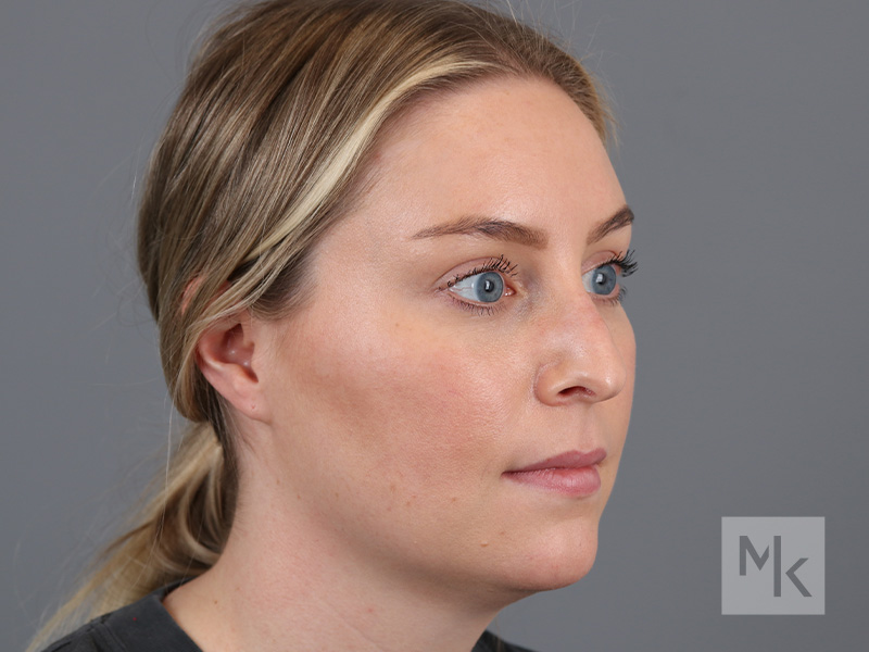 Rhinoplasty Before and After | Dr. Michael Kim