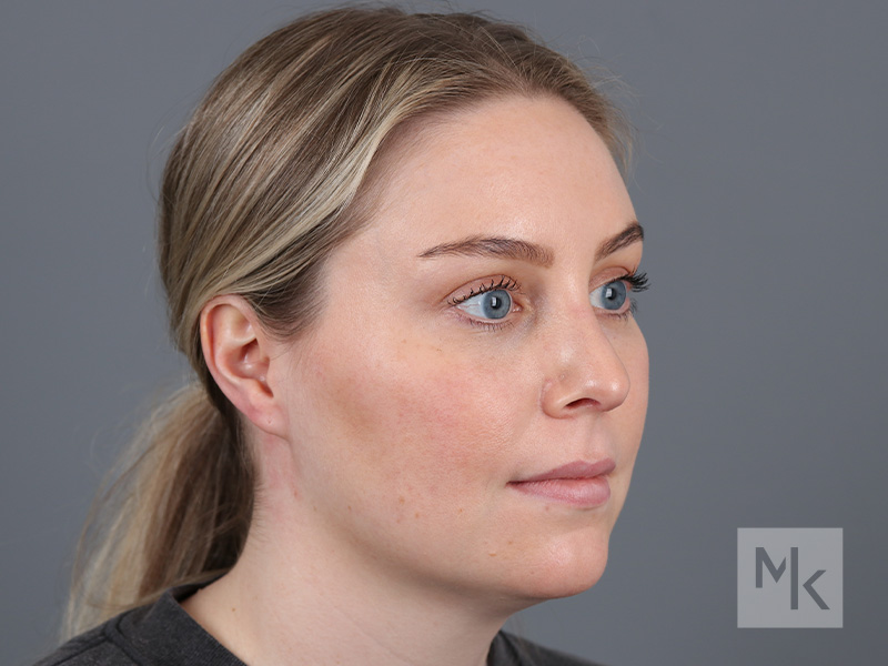 Rhinoplasty Before and After | Dr. Michael Kim