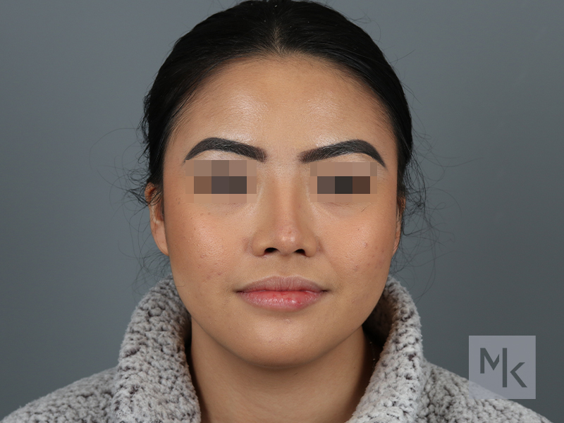 Rhinoplasty Before and After | Dr. Michael Kim