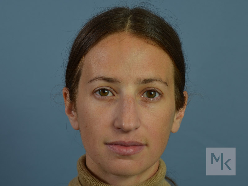 Rhinoplasty Before and After | Dr. Michael Kim