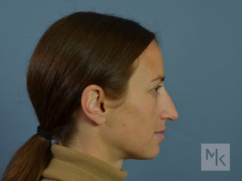 Rhinoplasty Before and After | Dr. Michael Kim