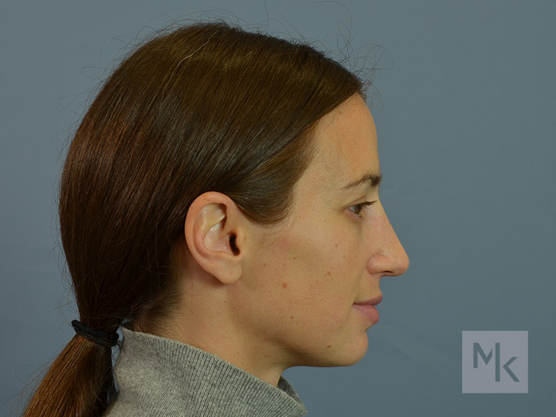 Rhinoplasty Before and After | Dr. Michael Kim