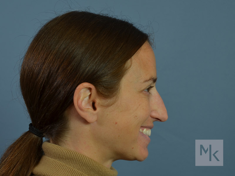 Rhinoplasty Before and After | Dr. Michael Kim