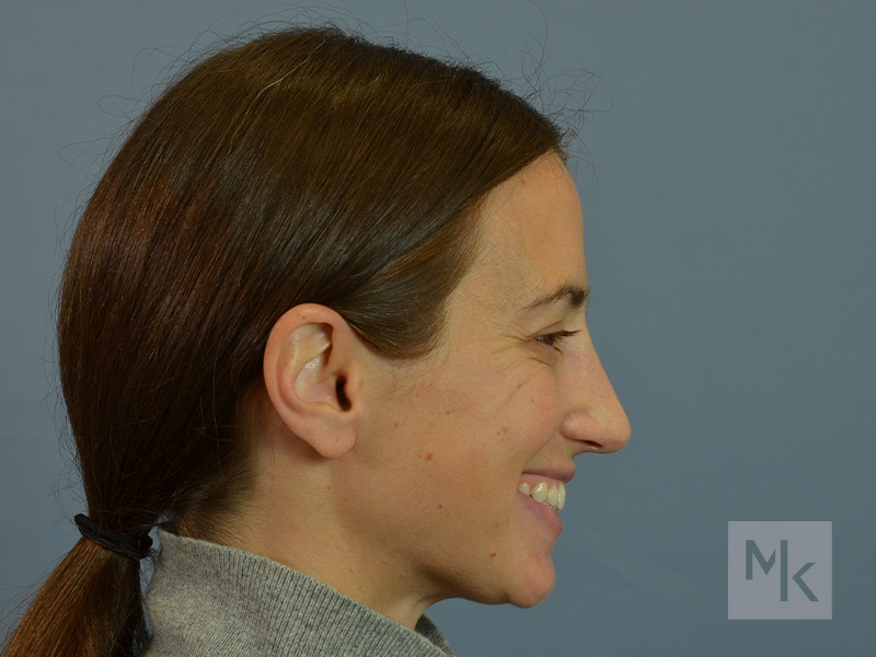 Rhinoplasty Before and After | Dr. Michael Kim