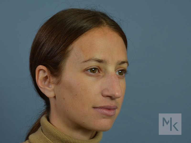 Rhinoplasty Before and After | Dr. Michael Kim